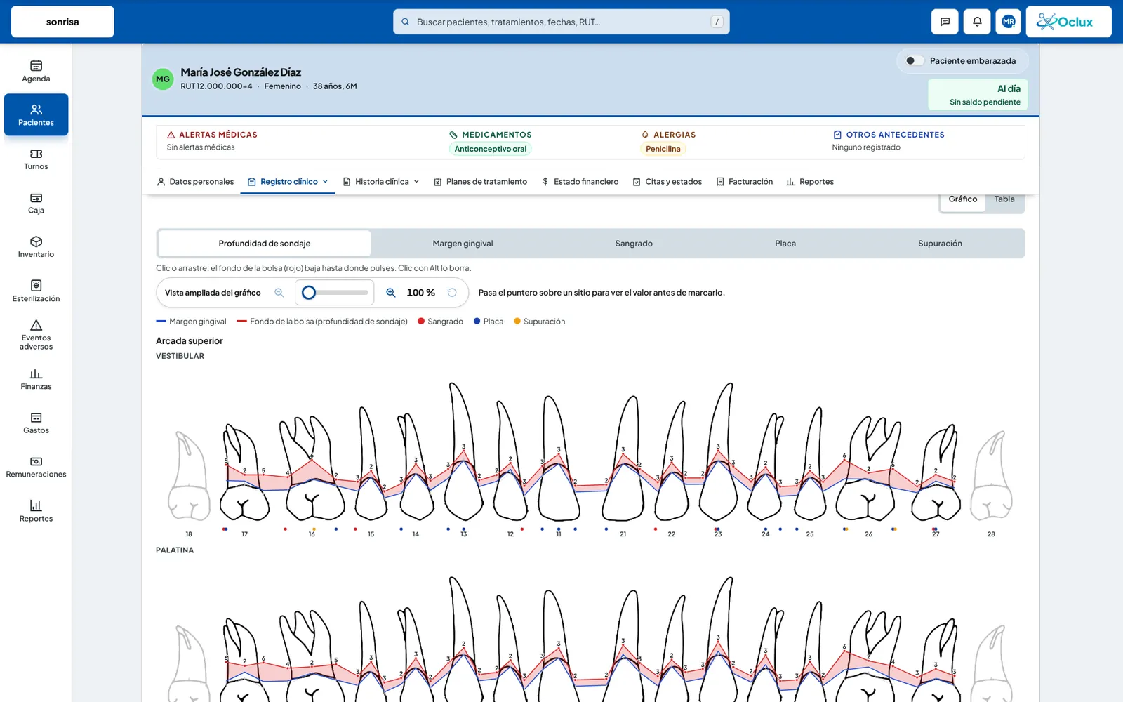 Oclux: periodontograma con profundidad de sondaje, margen gingival, sangrado, placa y supuración
